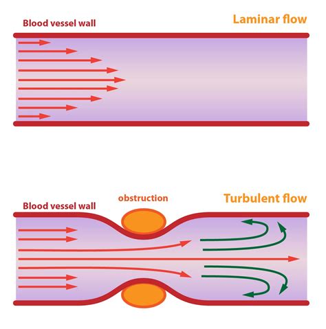 Irregular thickening can lead to a host of complications as it may result in weakening of the wall over time, cause turbulent blood flow within the vessel or narrow the. . What causes turbulent flow in blood vessels in the neck or head